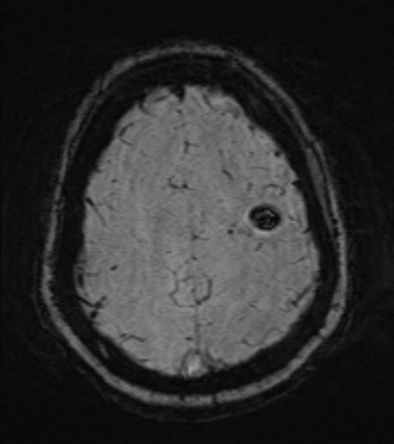 Cerebral venous infarct (Radiopaedia 53627-59685 Axial SWI 43).jpg