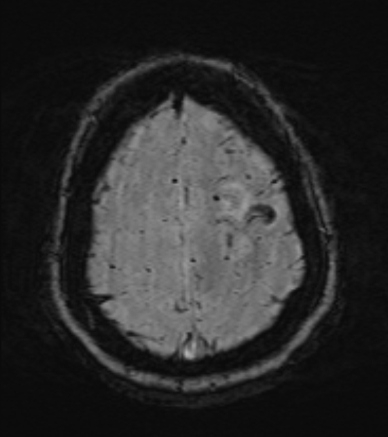 Cerebral venous infarct (Radiopaedia 53627-59685 Axial SWI 46).jpg