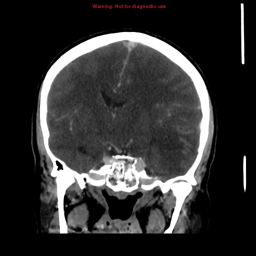 Cerebral venous infarction (Radiopaedia 12404-20735 B 39).jpg