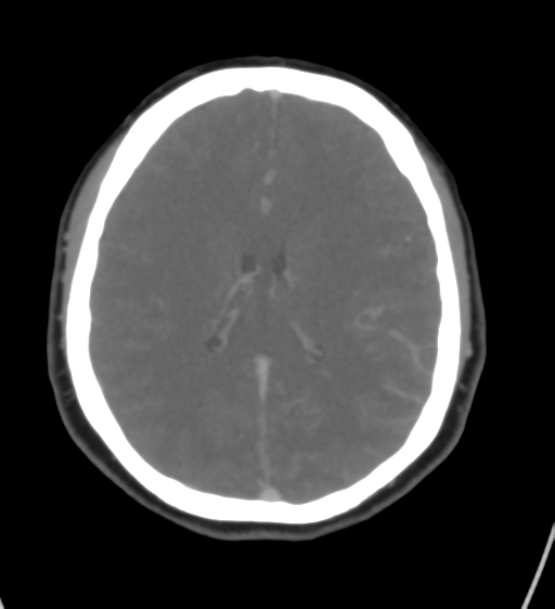 Cerebral venous infarction due to transverse sinus thrombosis (Radiopaedia 34688-36120 Axial CT venogram 31).png