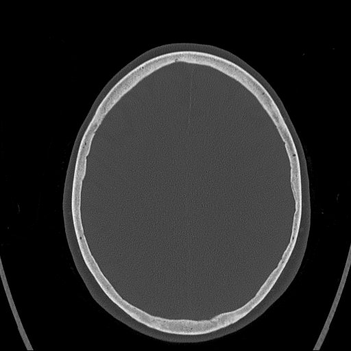 Cerebral venous infarction with hemorrhage (Radiopaedia 65343-74381 Axial bone window 128).jpg