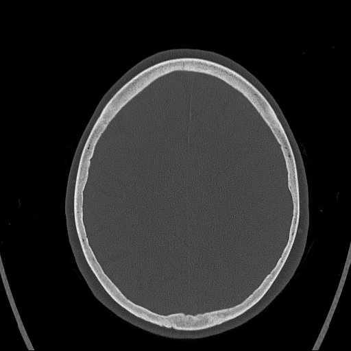 Cerebral venous infarction with hemorrhage (Radiopaedia 65343-74381 Axial bone window 135).jpg