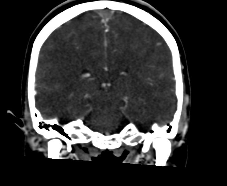 Cerebral venous sinus thrombosis (Radiopaedia 59224-66646 Coronal C+ delayed 44).jpg