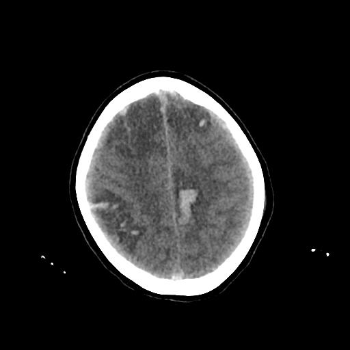 Cerebral venous throbmosis - hemorrhagic venous infarction (Radiopaedia 87318-103613 Axial non-contrast 129).jpg