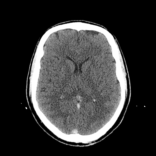 File:Cerebral venous thrombosis (CVT) (Radiopaedia 77524-89685 Axial non-contrast 26).jpg
