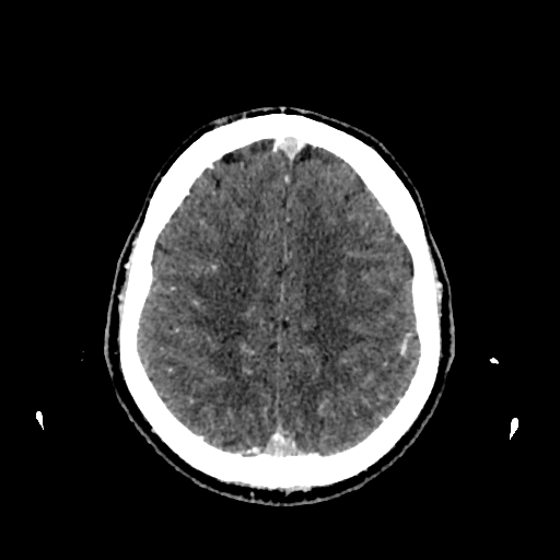 File:Cerebral venous thrombosis (CVT) (Radiopaedia 77524-89685 Axial with contrast 28).jpg