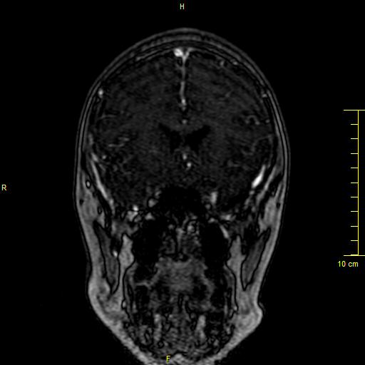Cerebral venous thrombosis (Radiopaedia 23288-23351 MRV 32).JPG