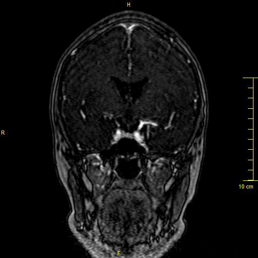 Cerebral venous thrombosis (Radiopaedia 23288-23351 MRV 54).JPG