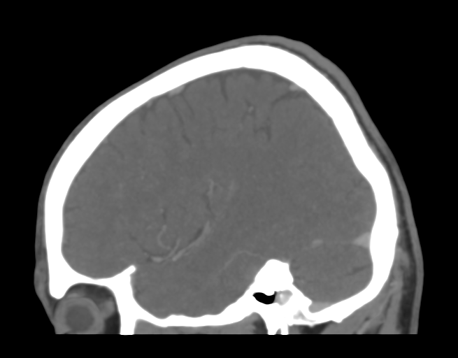 Cerebral venous thrombosis (Radiopaedia 38392-40467 D 40).png