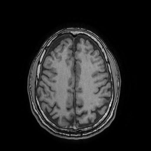 Cerebral venous thrombosis with secondary intracranial hypertension (Radiopaedia 89842-106957 Axial T1 125).jpg