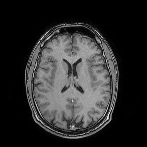File:Cerebral venous thrombosis with secondary intracranial hypertension (Radiopaedia 89842-106957 Axial T1 C+ 108).jpg