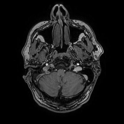 File:Cerebral venous thrombosis with secondary intracranial hypertension (Radiopaedia 89842-106957 Axial T1 C+ 43).jpg