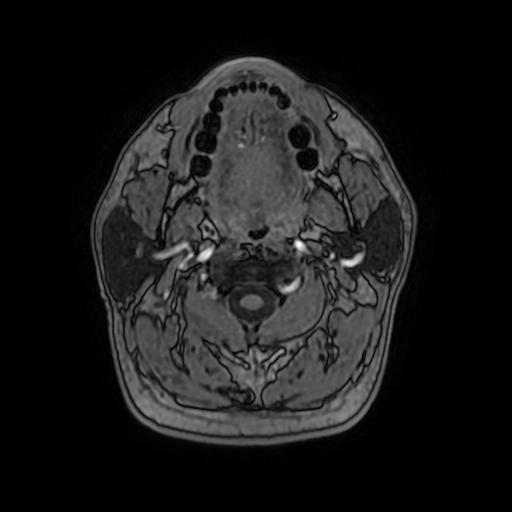 File:Cerebral venous thrombosis with secondary intracranial hypertension (Radiopaedia 89842-106957 Axial T1 C+ 9).jpg