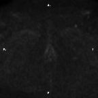 Cervical adenocarcinoma (Radiopaedia 65011-73985 Axial DWI 5).jpg