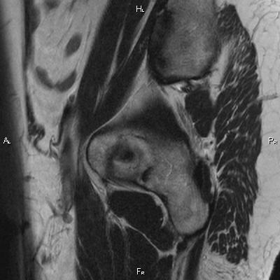 File:Cervical adenocarcinoma (Radiopaedia 65011-73985 Sagittal T2 30).jpg