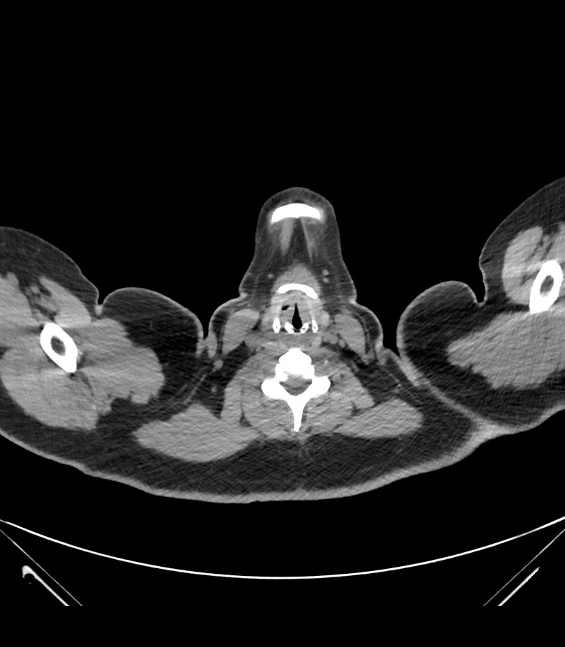 Cervical aortic arch with coarctation and aneurysms (Radiopaedia 44035-47552 Axial non-contrast 1).jpg