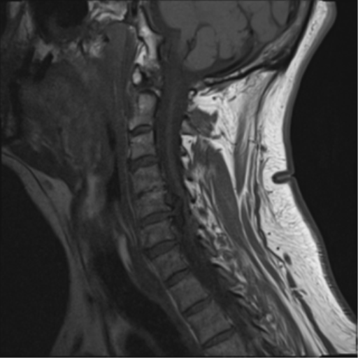 File:Cervical canal stenosis due to ossification of the posterior longitudinal ligament (Radiopaedia 47260-51824 Sagittal T1 10).png