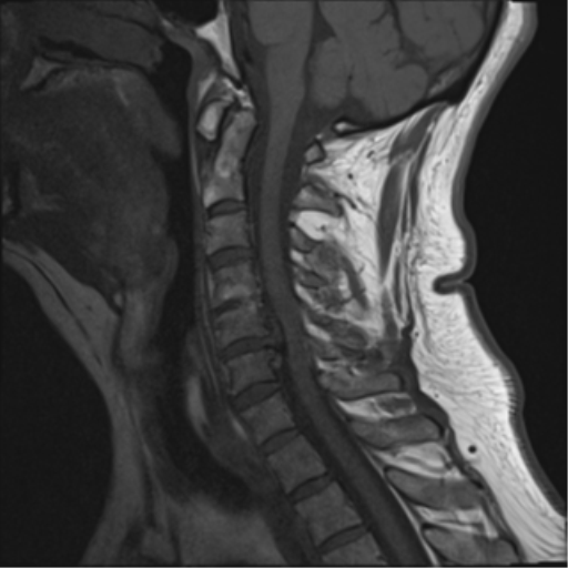 File:Cervical canal stenosis due to ossification of the posterior longitudinal ligament (Radiopaedia 47260-51824 Sagittal T1 7).png