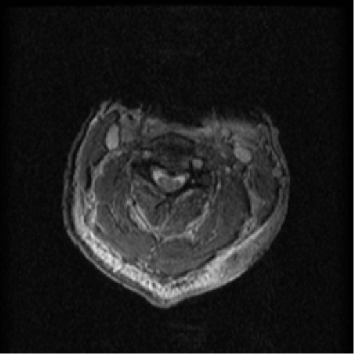 File:Cervical canal stenosis with cord compression (Radiopaedia 34114-35374 Axial Gradient Echo 60).png