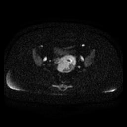 File:Cervical carcinoma (Radiopaedia 67644-77047 Axial DWI 11).jpg