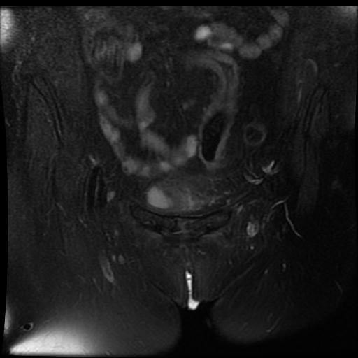 File:Cervical carcinoma (Radiopaedia 70924-81132 Coronal T2 fat sat 1).jpg