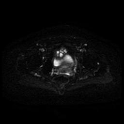 Cervical carcinoma (Radiopaedia 85405-101028 Axial DWI 7).jpg