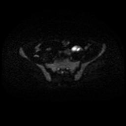 Cervical carcinoma (Radiopaedia 88010-104555 Axial DWI 40).jpg