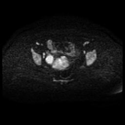 File:Cervical carcinoma (Radiopaedia 88010-104555 Axial DWI 51).jpg