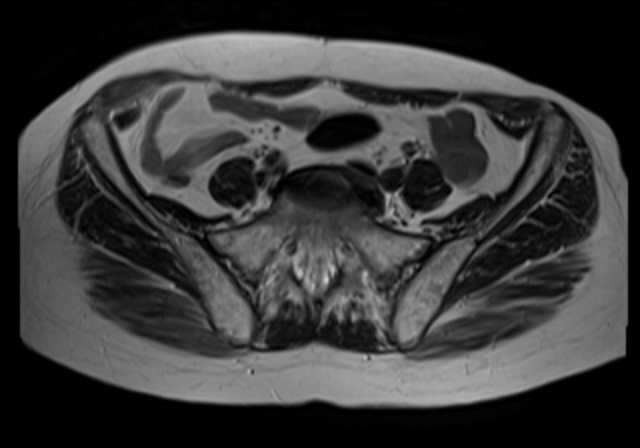 File:Cervical carcinoma (Radiopaedia 88312-104943 Sagittal T1 5).jpg
