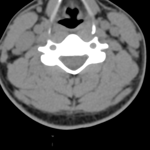 Cervical schwannoma (Radiopaedia 57979-64974 Axial non-contrast 37).png