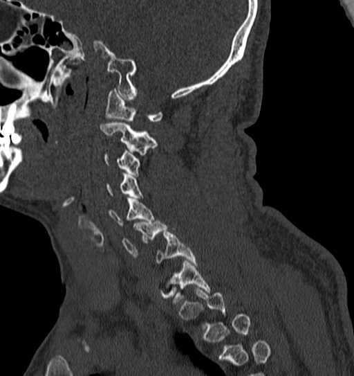 Cervical spine trauma with tear drop fracture and perched facet joint (Radiopaedia 53989-60127 Sagittal bone window 120).jpg