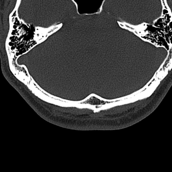 Cervical spondylodiscitis (Radiopaedia 28057-29489 Axial bone window 1).jpg