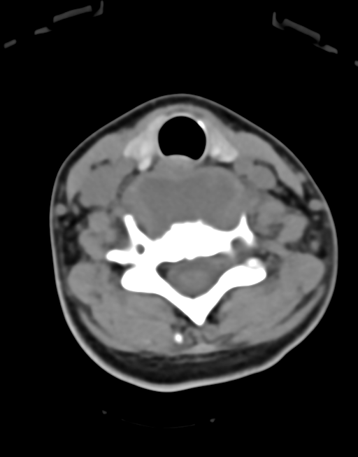 Cervical tuberculous spondylitis (Radiopaedia 39149-41365 Axial non-contrast 35).png