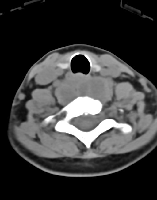 Cervical tuberculous spondylitis (Radiopaedia 39149-41365 Axial non-contrast 40).png