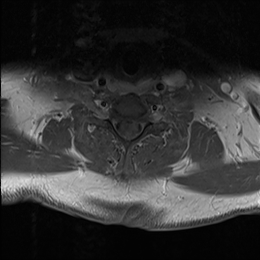 File:Cervical tumor-like myelopathy due to Type V dAVF (Radiopaedia 82461-96604 Axial T1 C+ fat sat 27).jpg