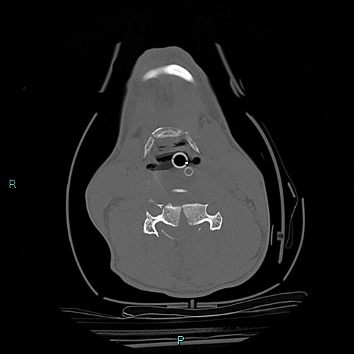 File:Cervical vertebral burst fracture (Radiopaedia 37420-39258 Axial bone window 32).jpg
