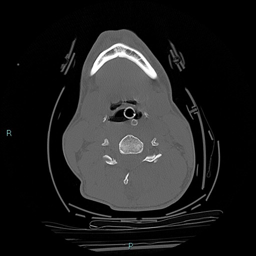 File:Cervical vertebral burst fracture (Radiopaedia 37420-39258 Axial bone window 42).jpg