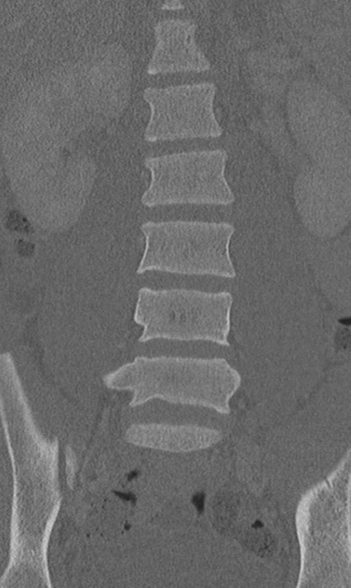 Chance fracture (Radiopaedia 40360-42912 Coronal bone window 26).png