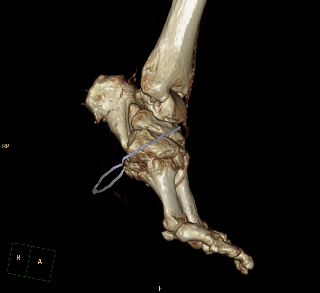 File:Charcot joint (Radiopaedia 36629-38194 3D bone window 4).jpg