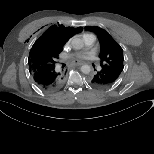 File:Chest multitrauma - aortic injury (Radiopaedia 34708-36147 A 148).png