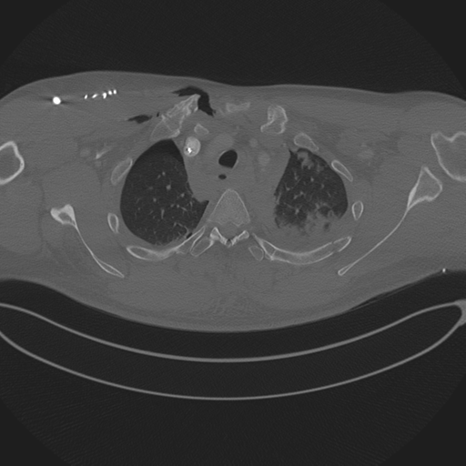 Chest multitrauma - aortic injury (Radiopaedia 34708-36147 Axial bone window 59).png