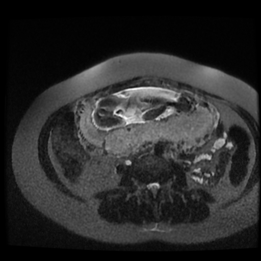 Chiari II malformation - fetal MRI (Radiopaedia 68099-77581 Axial T2-SSFSE 6).jpg