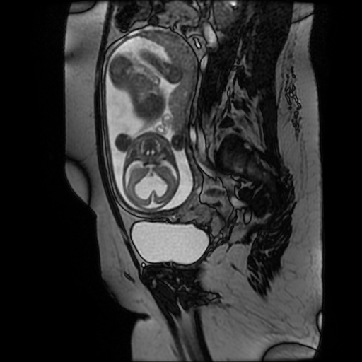 Chiari II malformation - fetal MRI (Radiopaedia 68099-77581 Sagittal Fiesta 22).jpg
