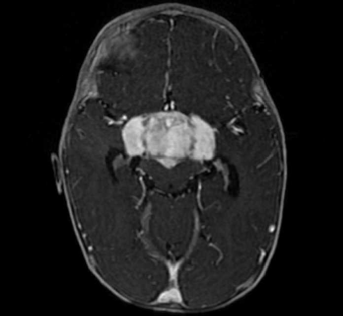 Chiasmatic-hypothalamic glioma (Radiopaedia 90079-107252 Axial T1 C+ 34).jpg