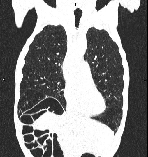 Chilaiditi sign (Radiopaedia 88839-105611 Coronal lung window 21).jpg