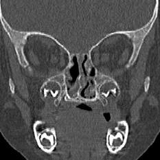 Choanal atresia (Radiopaedia 88525-105975 Coronal bone window 55).jpg