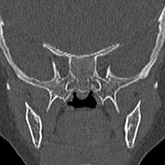 Choanal atresia (Radiopaedia 88525-105975 Coronal bone window 85).jpg
