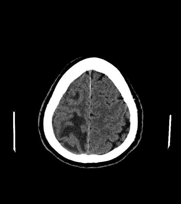 Cholangiocarcinoma with cerebral metastases (Radiopaedia 83519-98628 Axial non-contrast 54).jpg