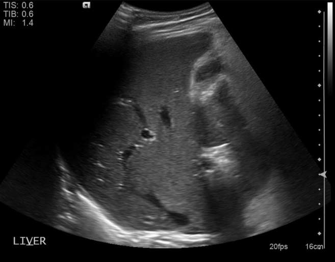 File:Cholecystitis - perforated gallbladder (Radiopaedia 57038-63913 A 1).jpg