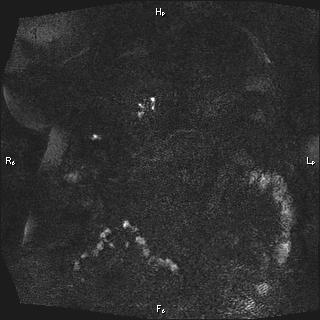 Choledochal cyst - type Ia (Radiopaedia 85673-101454 F 19).jpg